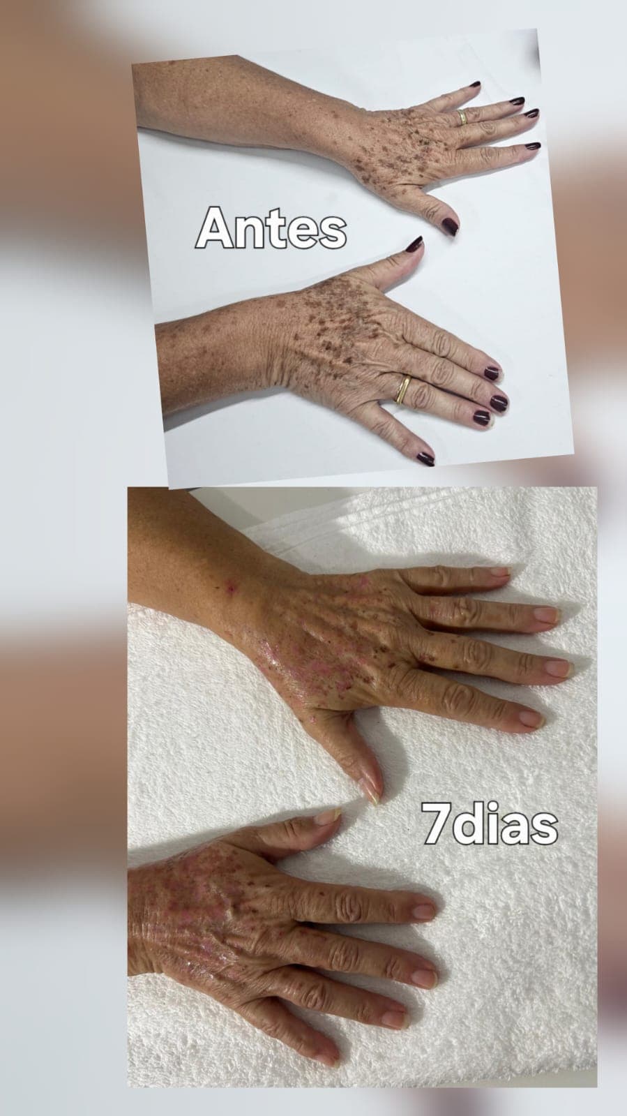 Manchas das mãos clareadas — Tratamento de Manchas