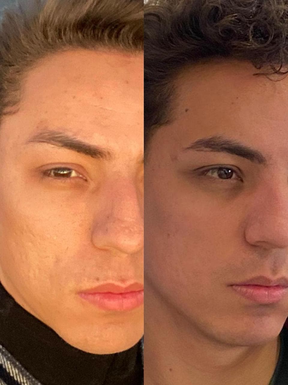 Cicatrizes de acne suavizadas — Laser de CO₂ / Microagulhamento
